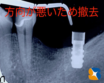 インプラント抜ける　確実なやり直し　インプラント再生医