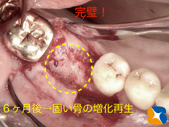 奈良　生駒　石切　大阪　痛くない怖くない再生医療インプラント