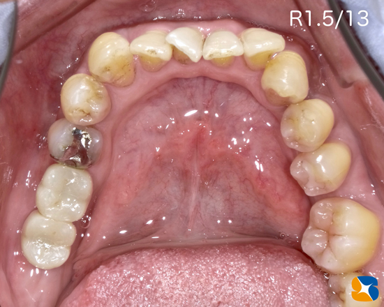 痛くない怖くない寝ながらインプラント　静脈麻酔　再生療法　奈良・生駒・東大阪