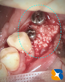 インプラント抜ける　確実なやり直し　インプラント再生医
