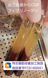 インプラント抜ける　確実なやり直し　インプラント再生医