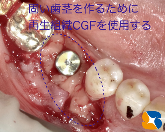 奈良　生駒　石切　大阪　痛くない怖くない再生医療インプラント