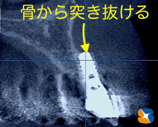 奈良　大阪　インプラント　安全　確実　点滴　良心的　経験豊富