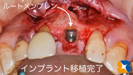 インプラント　奈良　生駒　大阪　静脈麻酔鎮静　無料　最新治療　再生医療