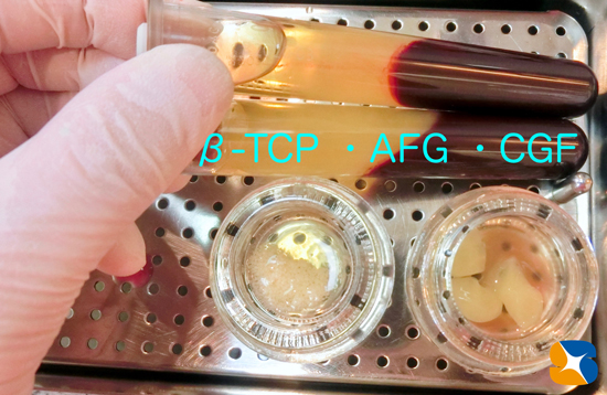 インプラント　奈良　生駒　大阪　静脈麻酔鎮静　無料　最新治療　再生医療