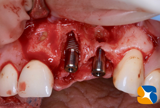 奈良　大阪　インプラント　安全　確実　点滴　良心的　経験豊富