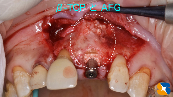インプラント　奈良　生駒　大阪　静脈麻酔鎮静　無料　最新治療　再生医療