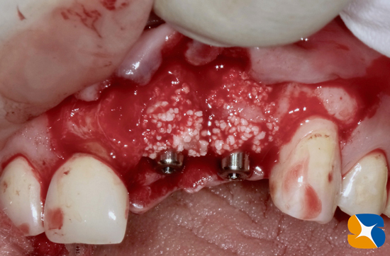 奈良　大阪　インプラント　安全　確実　点滴　良心的　経験豊富