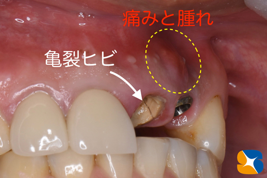 奈良　大阪　インプラント　安全　確実　点滴　良心的　経験豊富
