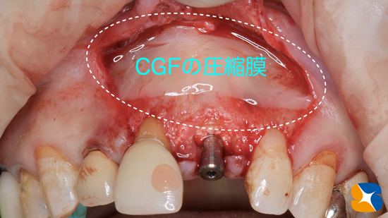 インプラント　奈良　生駒　大阪　静脈麻酔鎮静　無料　最新治療　再生医療