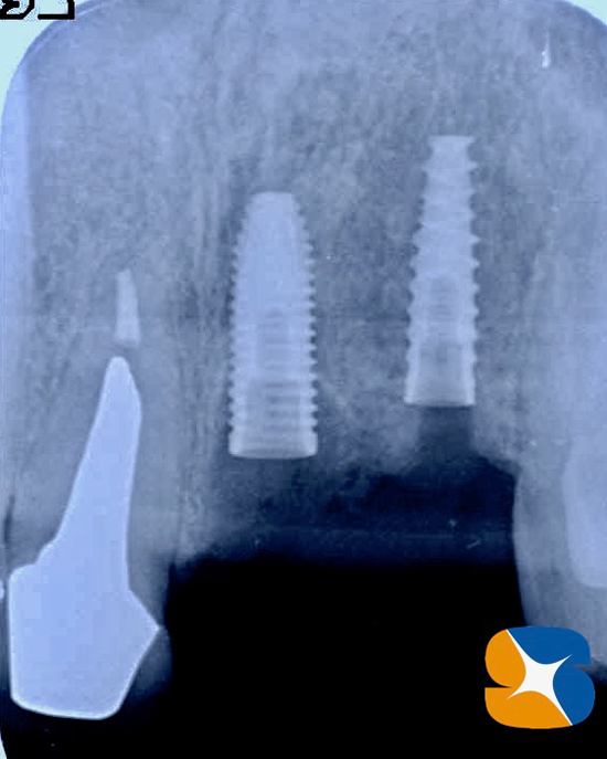 奈良　大阪　インプラント　安全　確実　点滴　良心的　経験豊富