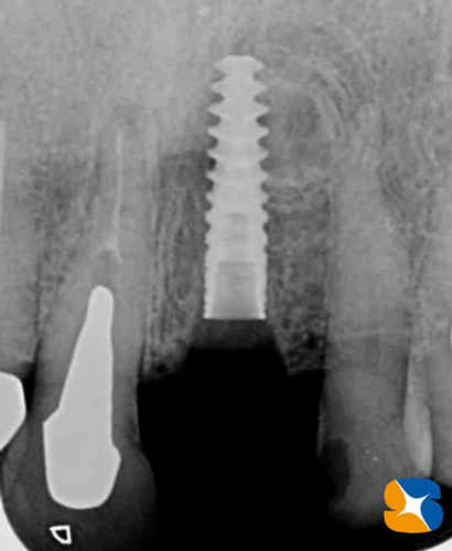 インプラント　奈良　生駒　大阪　静脈麻酔鎮静　無料　最新治療　再生医療