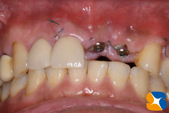 奈良　大阪　インプラント　安全　確実　点滴　良心的　経験豊富