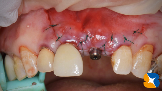 インプラント　奈良　生駒　大阪　静脈麻酔鎮静　無料　最新治療　再生医療