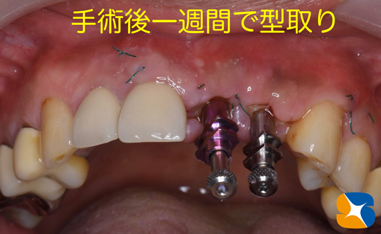 奈良　大阪　インプラント　安全　確実　点滴　良心的　経験豊富