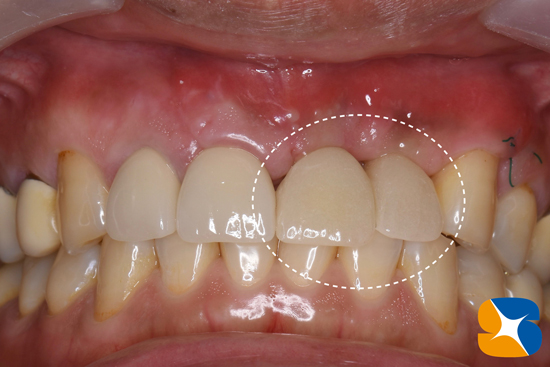 奈良　大阪　インプラント　安全　確実　点滴　良心的　経験豊富