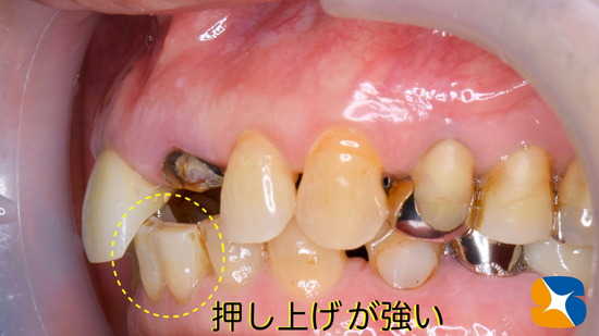 インプラント　奈良　生駒　大阪　静脈麻酔鎮静　無料　最新治療　再生医療