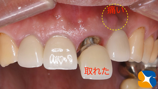 奈良　大阪　インプラント　安全　確実　点滴　良心的　経験豊富
