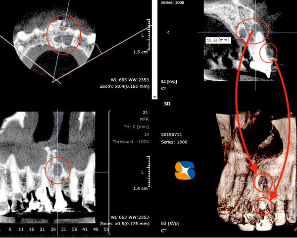 インプラント　奈良　生駒　大阪　静脈麻酔鎮静　無料　最新治療　再生医療