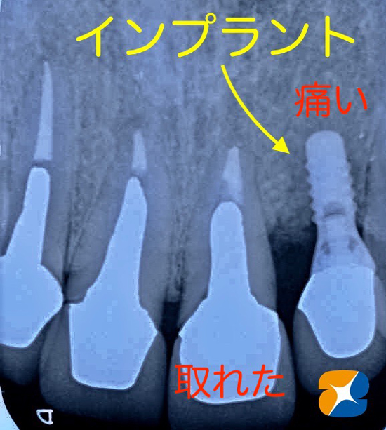 奈良　大阪　インプラント　安全　確実　点滴　良心的　経験豊富