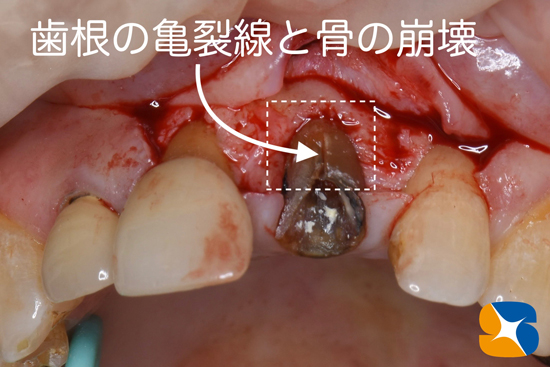インプラント　奈良　生駒　大阪　静脈麻酔鎮静　無料　最新治療　再生医療