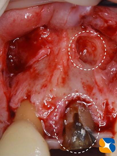 インプラント　奈良　生駒　大阪　静脈麻酔鎮静　無料　最新治療　再生医療