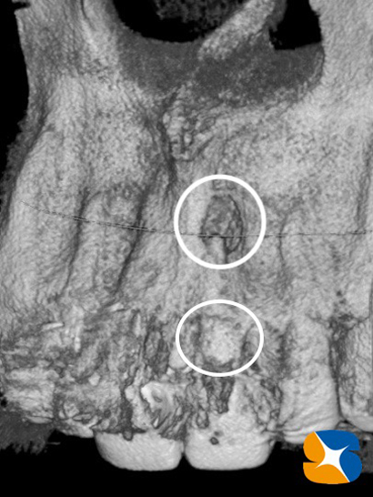 インプラント　奈良　生駒　大阪　静脈麻酔鎮静　無料　最新治療　再生医療