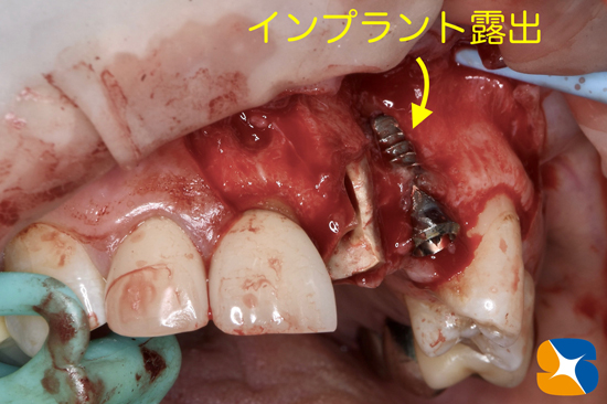 奈良　大阪　インプラント　安全　確実　点滴　良心的　経験豊富