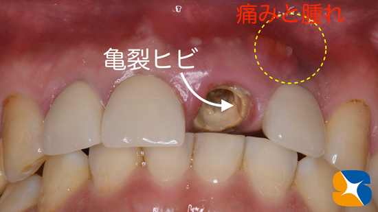 奈良　大阪　インプラント　安全　確実　点滴　良心的　経験豊富