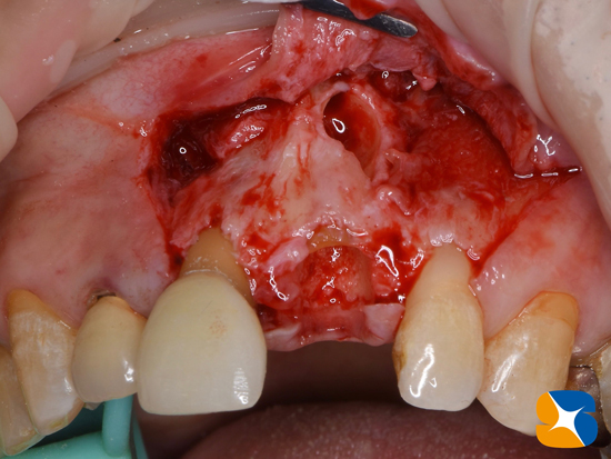インプラント　奈良　生駒　大阪　静脈麻酔鎮静　無料　最新治療　再生医療