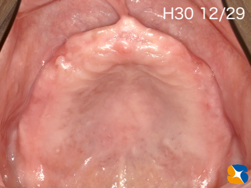 大阪　奈良市　生駒市　インプラント　静脈麻酔鎮静　リラックス　再生医療