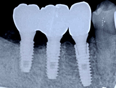 常時ー静脈麻酔鎮静　再生医療　良心的価格　石切　生駒　奈良　インプラント特化
