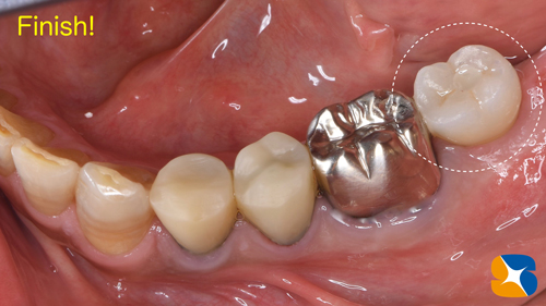 学園前　生駒　西大寺　石切　再生治療歯科　無料の静脈麻酔鎮静法