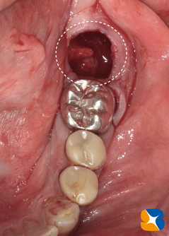 学園前　生駒　西大寺　石切　再生治療歯科　無料の静脈麻酔鎮静法