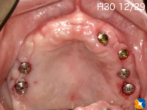 大阪　奈良市　生駒市　インプラント　静脈麻酔鎮静　リラックス　再生医療