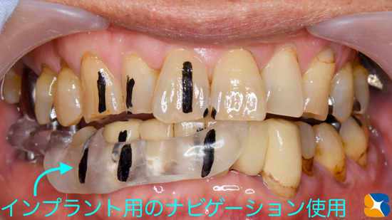 奈良　生駒　石切　インプラント　寝ながら無痛インプラント　良心価格　10年保証　再生医療