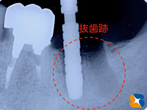 学園前　生駒　西大寺　石切　再生治療歯科　無料の静脈麻酔鎮静法