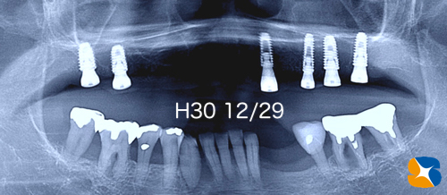 大阪　奈良市　生駒市　インプラント　静脈麻酔鎮静　リラックス　再生医療