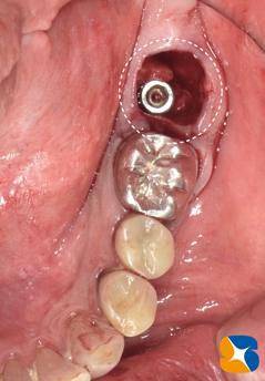 学園前　生駒　西大寺　石切　再生治療歯科　無料の静脈麻酔鎮静法