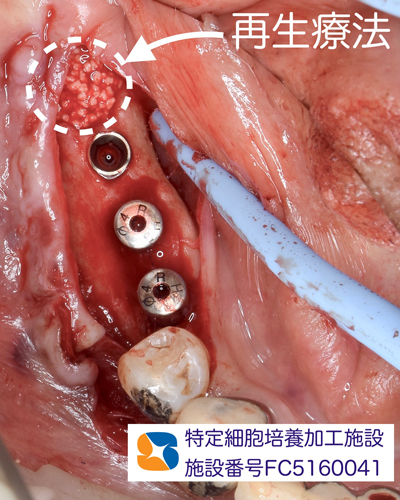奈良　生駒　石切　インプラント　寝ながら無痛インプラント　良心価格　10年保証　再生医療