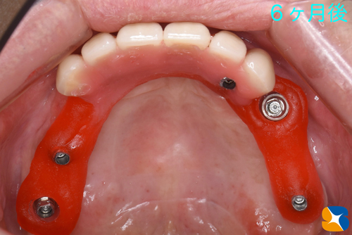 大阪　奈良市　生駒市　静脈麻酔鎮静　インプラント　寝ながら　ウトウト　石切　再生医療