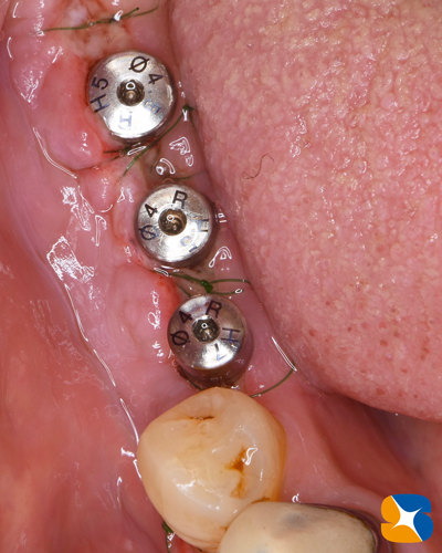 奈良　生駒　石切　インプラント　寝ながら無痛インプラント　良心価格　10年保証　再生医療