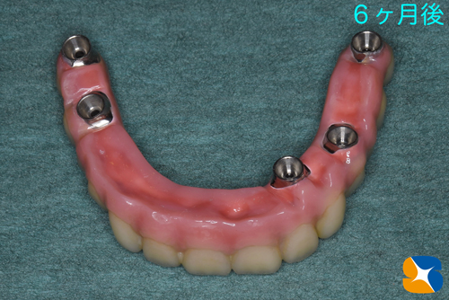 大阪　奈良市　生駒市　インプラント　静脈麻酔鎮静　リラックス　再生医療