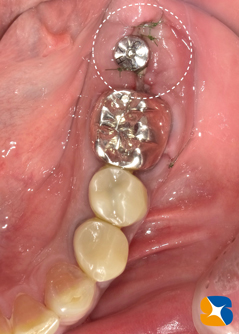 学園前　生駒　西大寺　石切　再生治療歯科　無料の静脈麻酔鎮静法