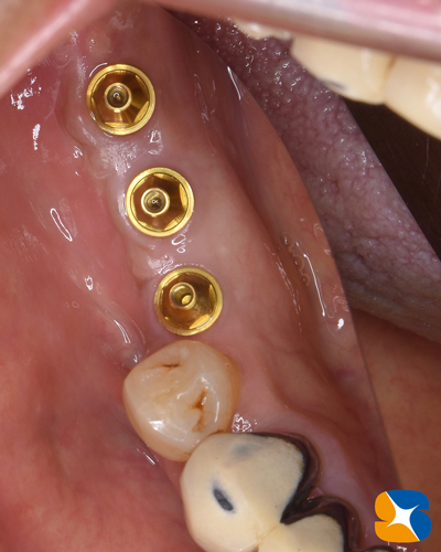 奈良　生駒　石切　インプラント　寝ながら無痛インプラント　良心価格　10年保証　再生医療