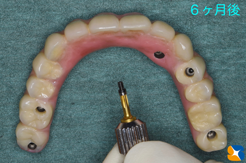 大阪　奈良市　生駒市　インプラント　静脈麻酔鎮静　リラックス　再生医療