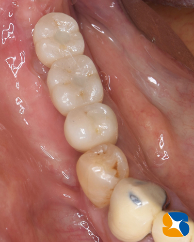 奈良　生駒　石切　インプラント　寝ながら無痛インプラント　良心価格　10年保証　再生医療
