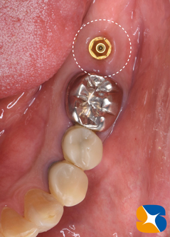学園前　生駒　西大寺　石切　再生治療歯科　無料の静脈麻酔鎮静法