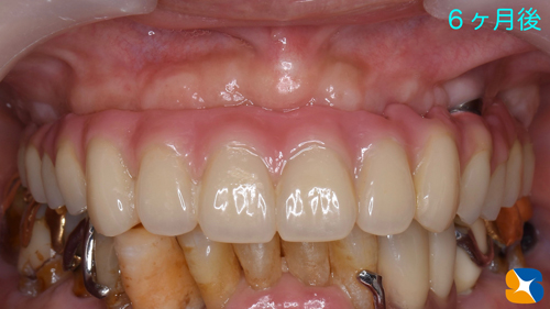 大阪　奈良市　生駒市　インプラント　静脈麻酔鎮静　リラックス　再生医療