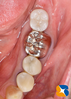 学園前　生駒　西大寺　石切　再生治療歯科　無料の静脈麻酔鎮静法